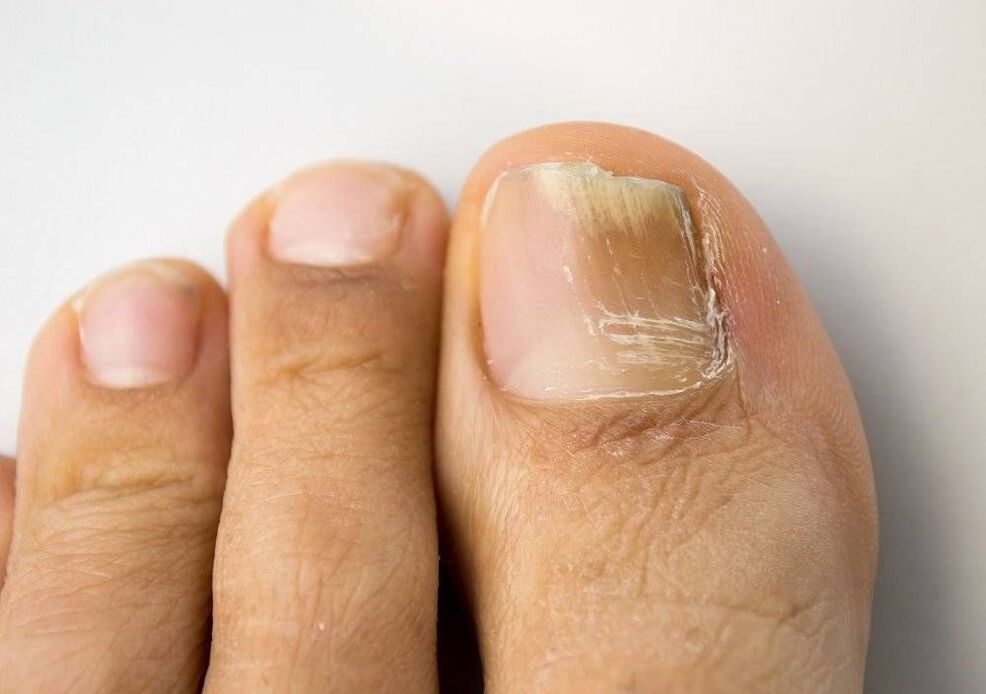 types of fungal infection in big toe