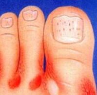The fungus on the legs
