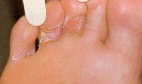 DERMAID INJURIES FOR RESALE FROM FEET