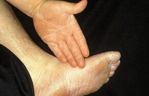 The erased form of microsis is manifested by peeling