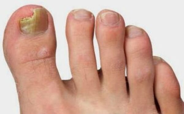 The fungus in the thumb of the leg