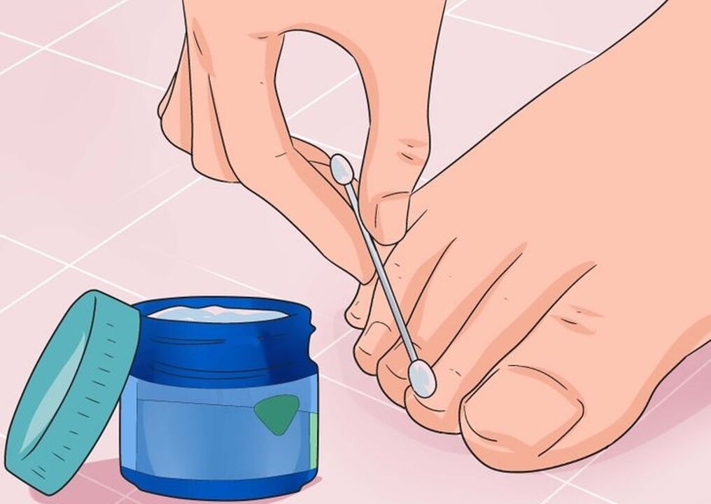 Cure the nail fungus