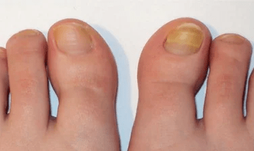 The early stage of nail fungus