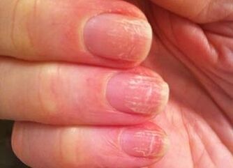 The early stage of the fungus on nails