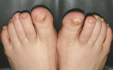 Fungus signs in nails