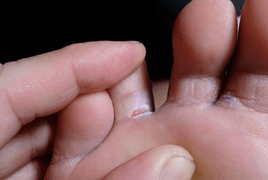 The appearance of bubble formations on the feet