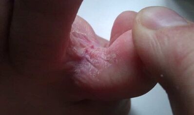 Stages of fungus development between the toes
