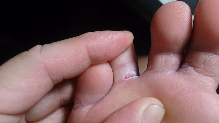 Foot fungus