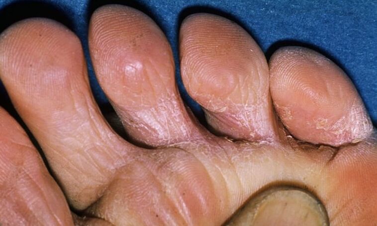 different types of fungi on the feet