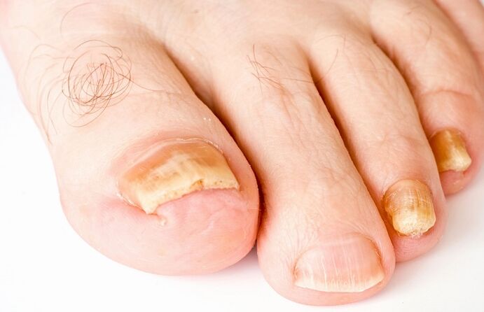 yellow nail due to fungal infection
