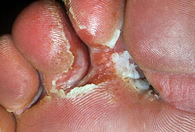 interdigital fungus symptoms