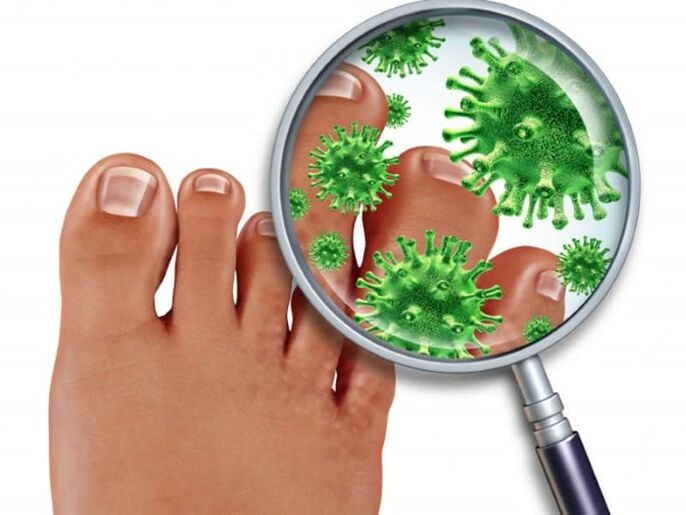 Nail fungus affects immunocompromised people