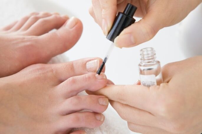 Regular application of medical varnish will speed up the treatment of onychomycosis