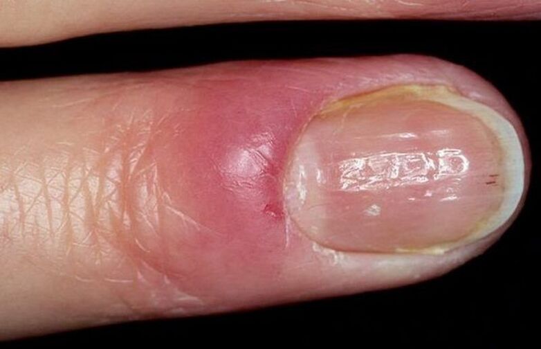 nail onisorexia