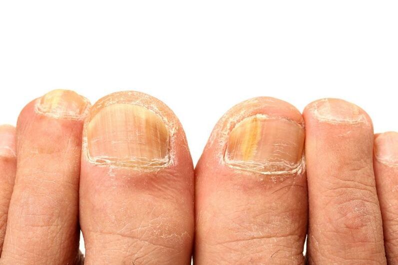 onychomycosis of nails